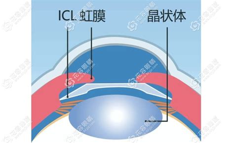 拱高|刘保松博士谈ICL晶体植入⑲： 破解拱高焦虑